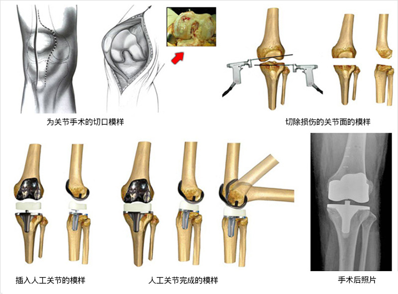 무릎 인공관절 치환술 사진