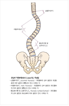 척추분리증으로 인한 척추전방전위증 환자의 수술전 사진