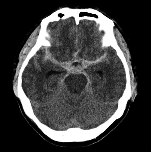 뇌CT에서 뇌지주막하출혈 소견이 보임