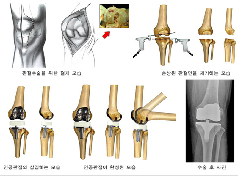 무릎 인공관절 치환술 사진