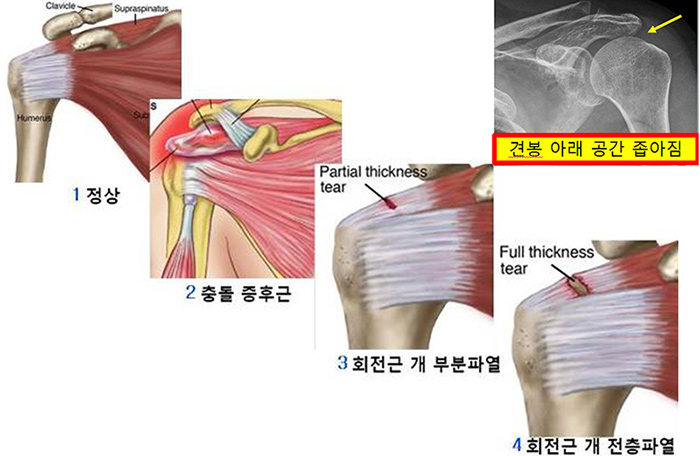 충돌증후군 & 어깨근개 파열 사진
