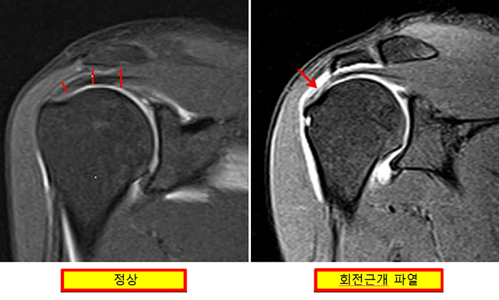 충돌증후군 & 어깨근개 파열 사진