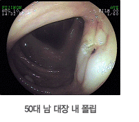 50대 남 대장 내 폴립